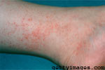 What is the diagnosis of Rocky Mountain spotted fever?